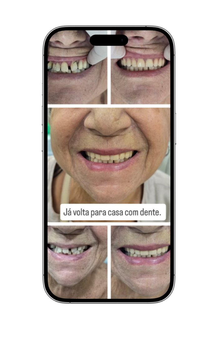 implantes 1