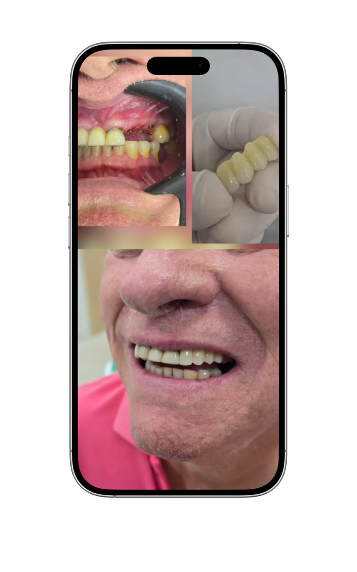 implantes 2