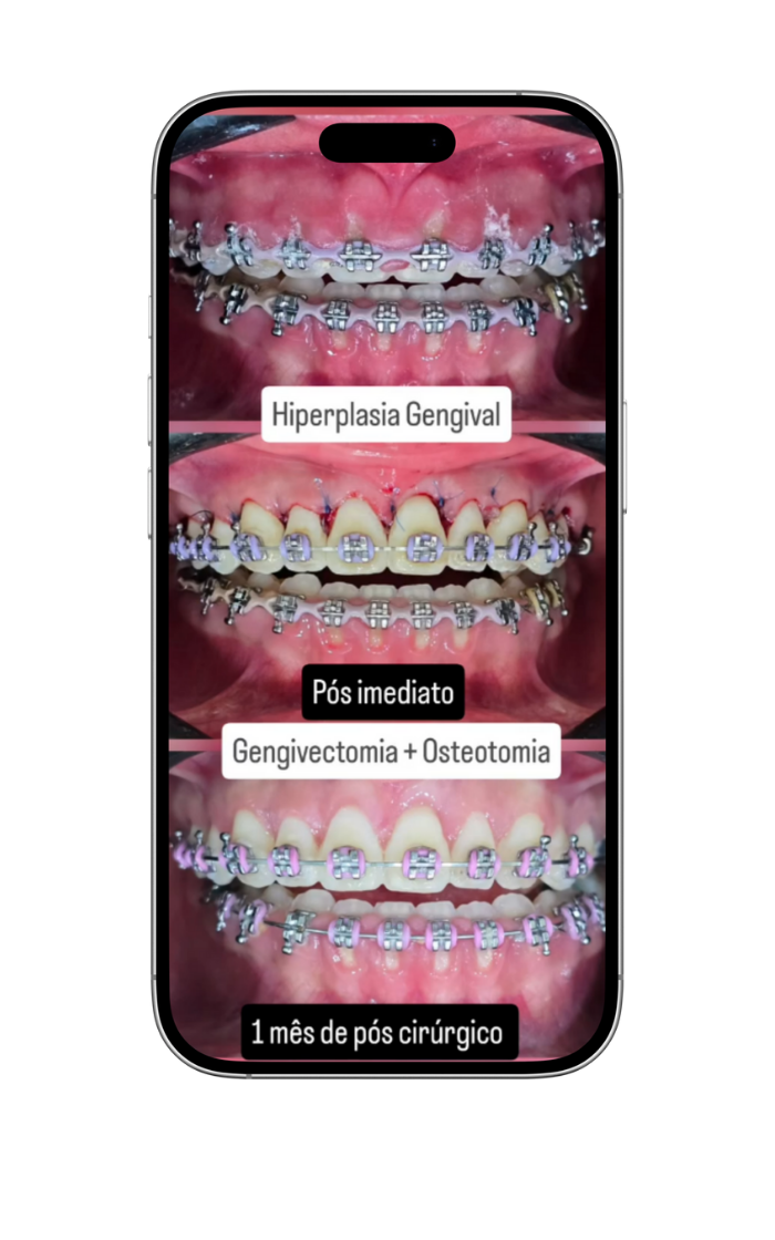 implantes 3