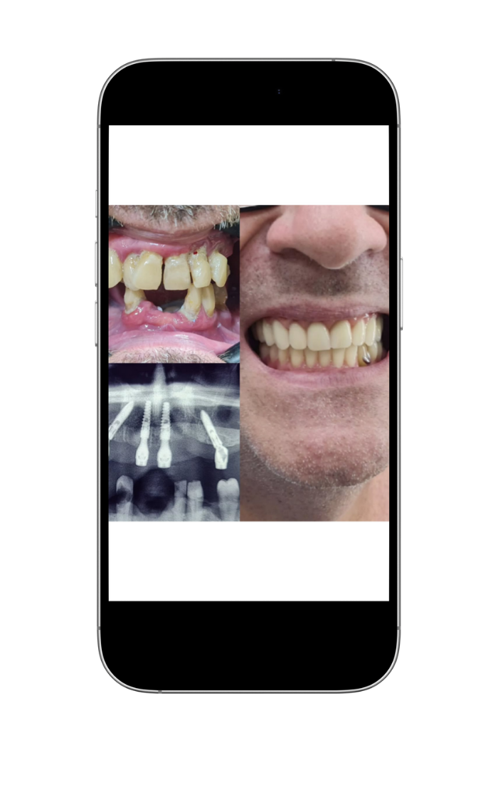implantes 4