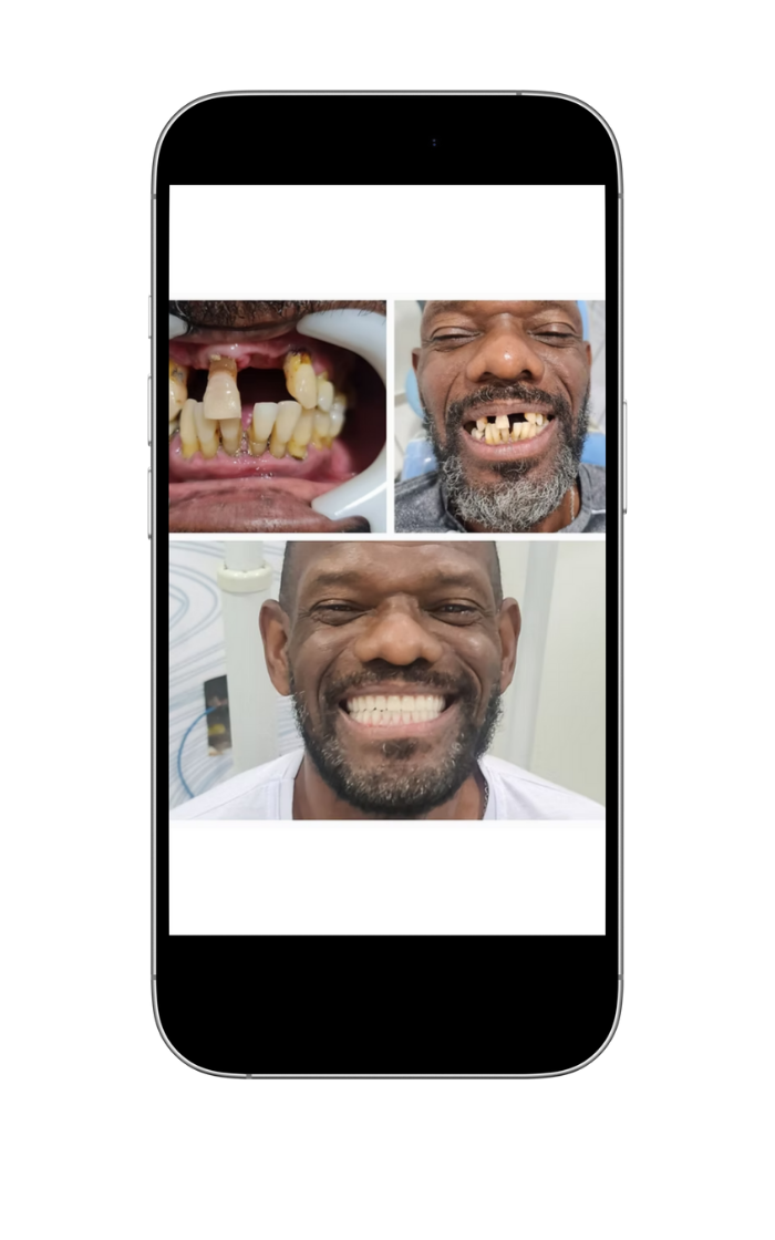 implantes 6